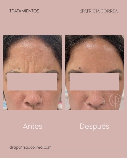 Antes y Despues Bótox Manresa