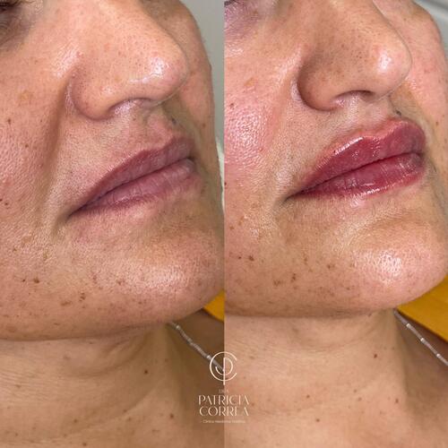 Aumento de Labios Ácido Hialurónico en Manresa