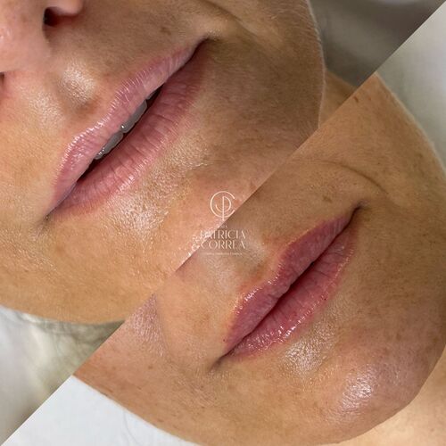 Aumento de Labios antes y despues en Manresa