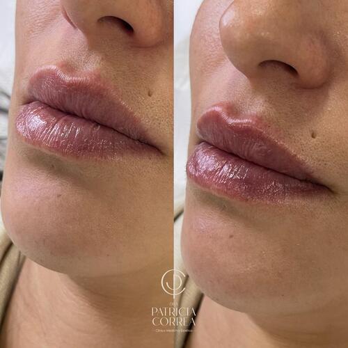 Aumento de Labios en Manresa