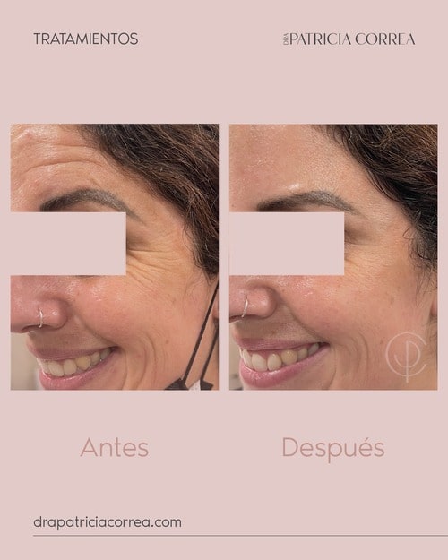 Bótox Manresa