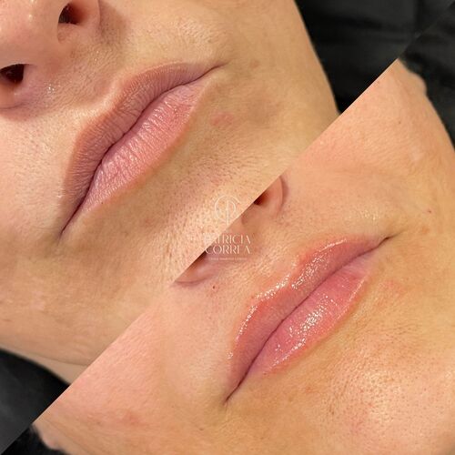 Clinica Aumento de Labios en Manresa