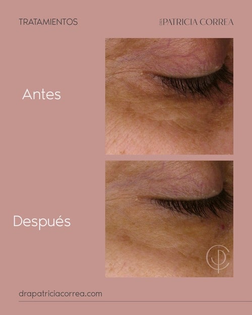LPG Endermologie