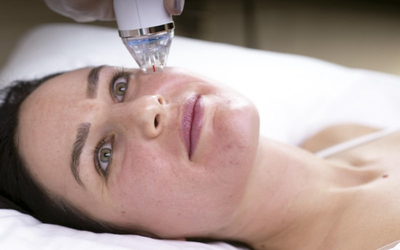 Radiofrecuencia fraccionada con microagujas