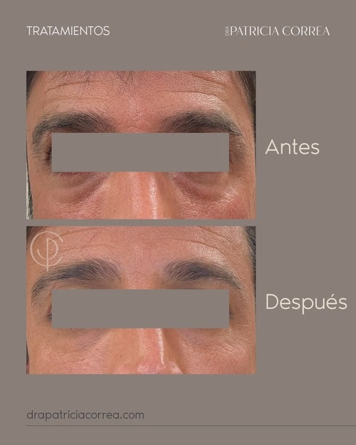 Relleno de Ojeras Manresa