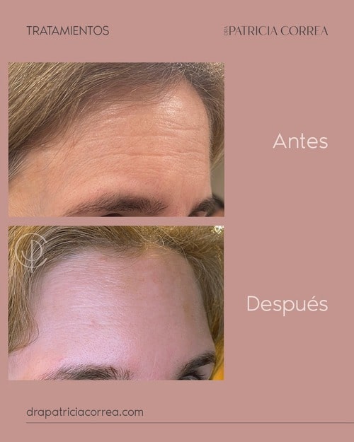 Tratamiento Bótox en Manresa